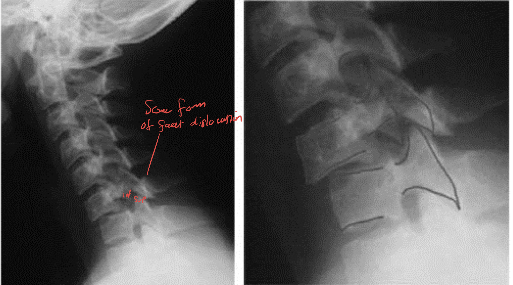 <ul><li><p>Flexion and rotation</p></li><li><p>Forces an inferior articular facet of an upper vertebra to pass superior and anterior to the superior articular facet of a lower vertebra</p></li><li><p>Rests in the IVF</p></li></ul><p></p>