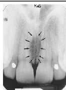 <p>Incisive Foramen</p>