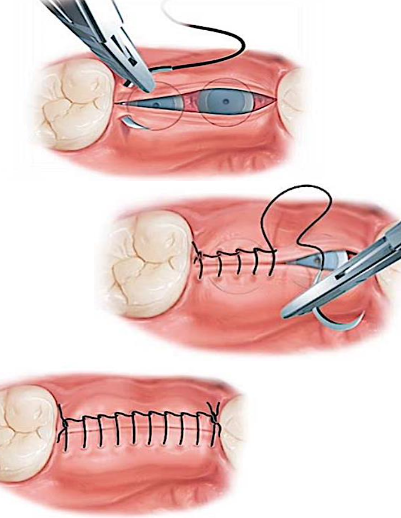 <p><span style="color: rgb(44, 44, 44);">similar to the simple continuous type, but the locking is provided by withdrawing the suture</span><span style="color: red;"> through its own loop</span></p><ul><li><p><strong>advantages:</strong></p><ul><li><p><span style="color: red;">reduced number of knots</span></p></li><li><p><span style="color: red;">uniform distribution of tension</span></p></li><li><p><span style="color: red;">prevents excessive tightening</span></p></li></ul></li><li><p><strong>disadvantages:</strong></p><ul><li><p><span style="color: red;">prevents the adjustment of tension over the wound</span><span> if tissue swelling occurs</span></p><p></p></li></ul></li></ul><p></p>