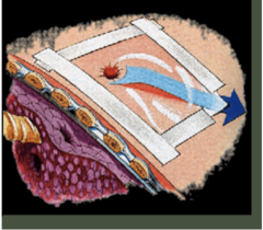 <p>what are the emergency interventions (ABCs) due to chest trauma</p>