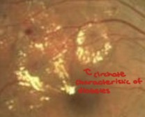 <p>How do the exudates appear with NPDR?</p>