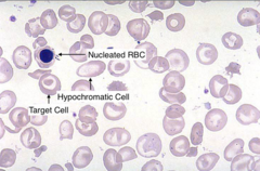 <p>Hgb < 10, severe poikilocytosis, hypochromia, microcytosis, target cells, basophilic stippling</p>