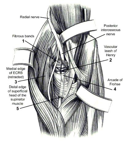 <p>Radial Tunnel Syndrome, <span>at the arcade of Frohse.</span></p>