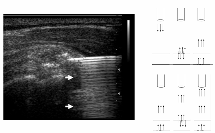 <p>waves can be scattered multiple times → multiple strong reflections between specular scatterers</p><ul><li><p>b-lines</p></li><li><p>comet-tails</p></li></ul><p></p><p>mirror-image artifact:</p><ul><li><p>beam hit large specular surface causing beam to reflect</p></li><li><p>reflected beam hits another surface and bounces back to the specular surface</p></li><li><p>produces a mirror image across the first specular boundary </p></li></ul><p></p>