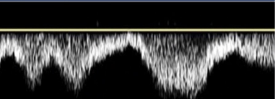 <p>best way to describe the venous flow pattern of this waveform?</p>