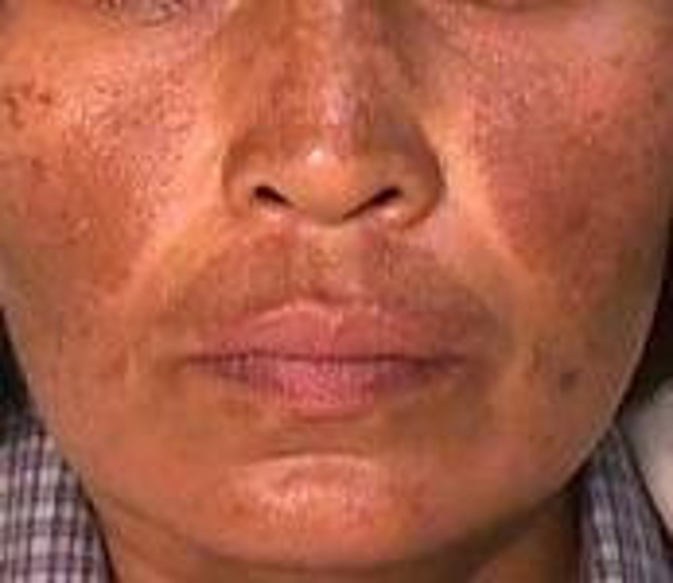 <p>Darker than normal pigmentation, appearing as dark splotches.</p>