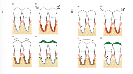 <p>-suprabony: jiggling forces did not result in loss of CT attachment, occlusal adjustment reduces the width of the PDL and less mobile teeth</p><p>-infrabony: enhanced loss of CT attachment and further downgrowth of the epithelium, occlusal adjustment did not improve attachment levels</p>