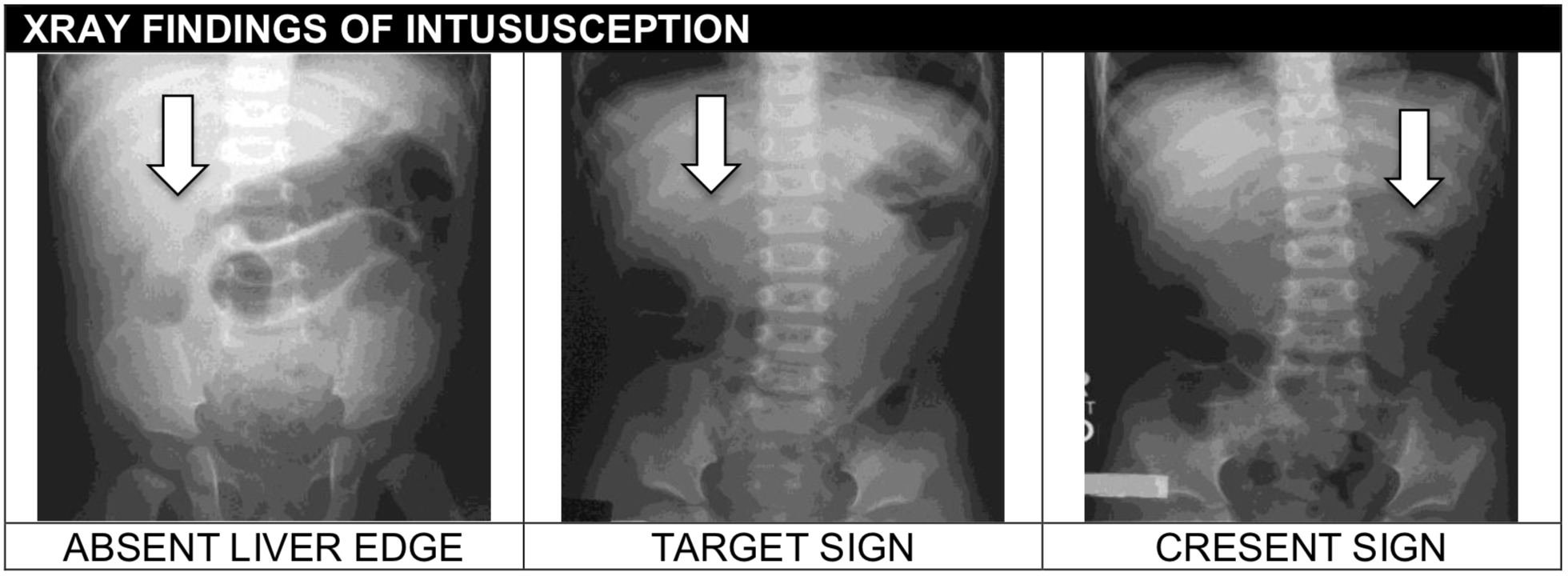 <p>intussusception</p>