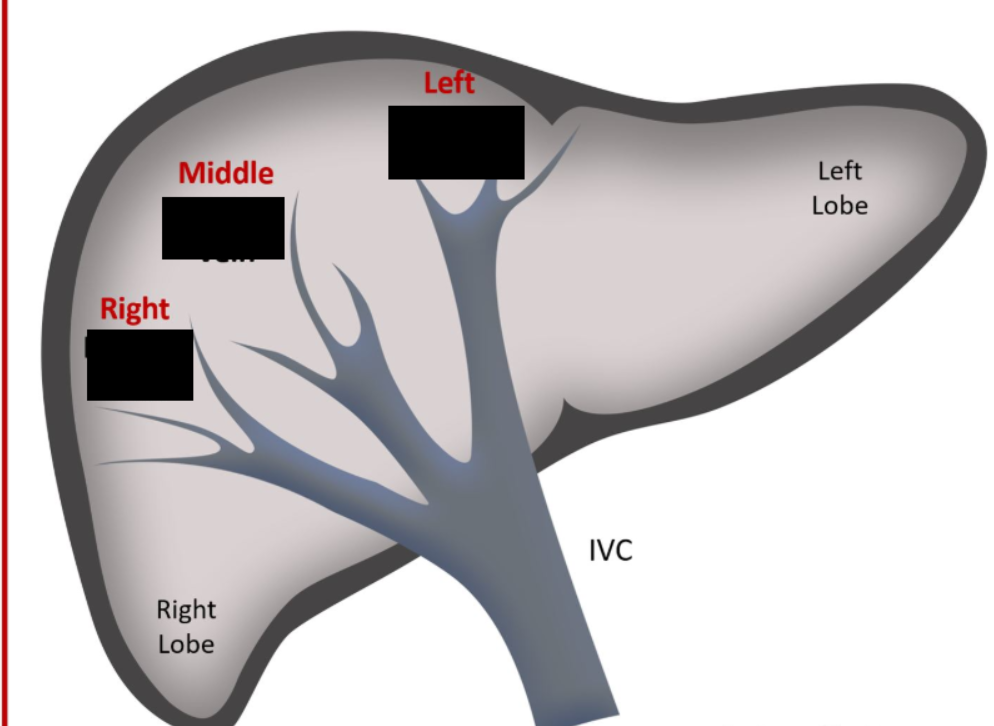 <p><span style="background-color: transparent;">Veins located inside of the liver, and are called the hepatic portal system. The liver requires a great deal of blood flow, and the veins account for the majority of blood in the liver. In diseases such as cirrhosis, the liver becomes fibrous, which increases resistance to blood flow in the veins.</span></p>
