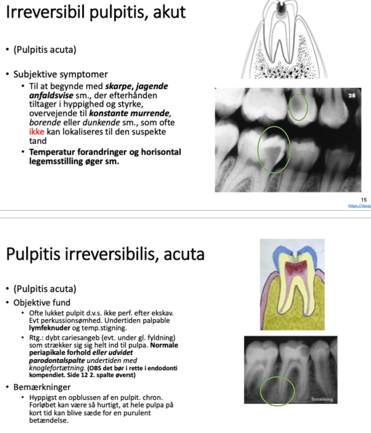 <p>Irreversibel pulpitis akut:</p><ul><li><p><span>Start: skarpe, jagende anfaldsvise smerter</span></p></li><li><p><span>Efterhånden: konstant murrende smerter</span></p></li><li><p><span>Kan ikke bedømme hvilken tand det er der gør ondt</span></p><ul><li><p>Pt har svært ved at fortælle hvilken tand det er, men kun lokalisere smerten i venstre eller højre side.</p><ul><li><p>Måden hvorpå man kan finde ud af om det er den ene eller anden tand der skaber smerten kan være ved at bedøve den ene og se om pt stadig har smerten.</p></li></ul></li></ul></li><li><p>Ikke altid man kan se noget på rtg. Billeeder</p><ul><li><p><span>Evt en udvidet rodhinde spalte og en fortætning i vævet ved apex. <br>- man ser dog ikke apikal opklaring endnu</span></p></li></ul></li></ul><p></p>