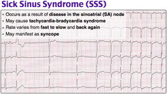 <p>C. sick sinus syndrome</p>