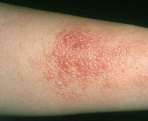 <p><span>A delayed hypersensitivity immune-mediated reaction caused by skin contact with an allergen. </span></p>