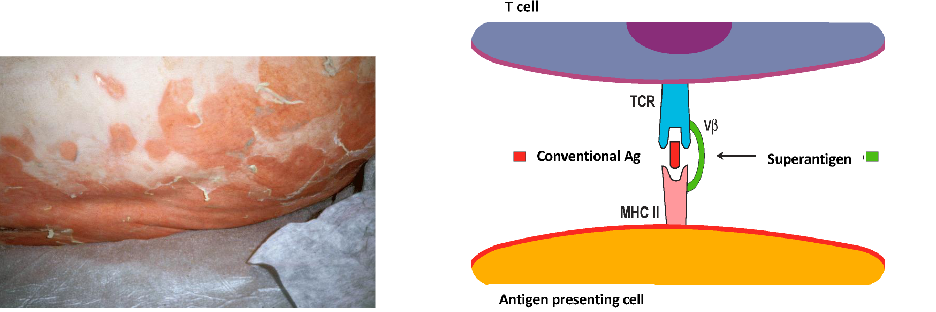 <p>STAPHYLOCOCCAL SCALDED SKIN SYNDROME (SSSS):</p><p>- caused by an enterotoxin, the gene fore which which originated in a bacteriophage (acquired by transduction)</p><p>- The enterotoxin is a 'superantigen'</p><p>- Superantigens bypass normal antigen presentation by directly crosslinking T cell receptor and MCH II</p><p>- causes polyclonal activation of T cells and an inflammatory cascade</p><p>.</p><p>- essentially it causes an inappropriate immune response, hence inflammation</p>