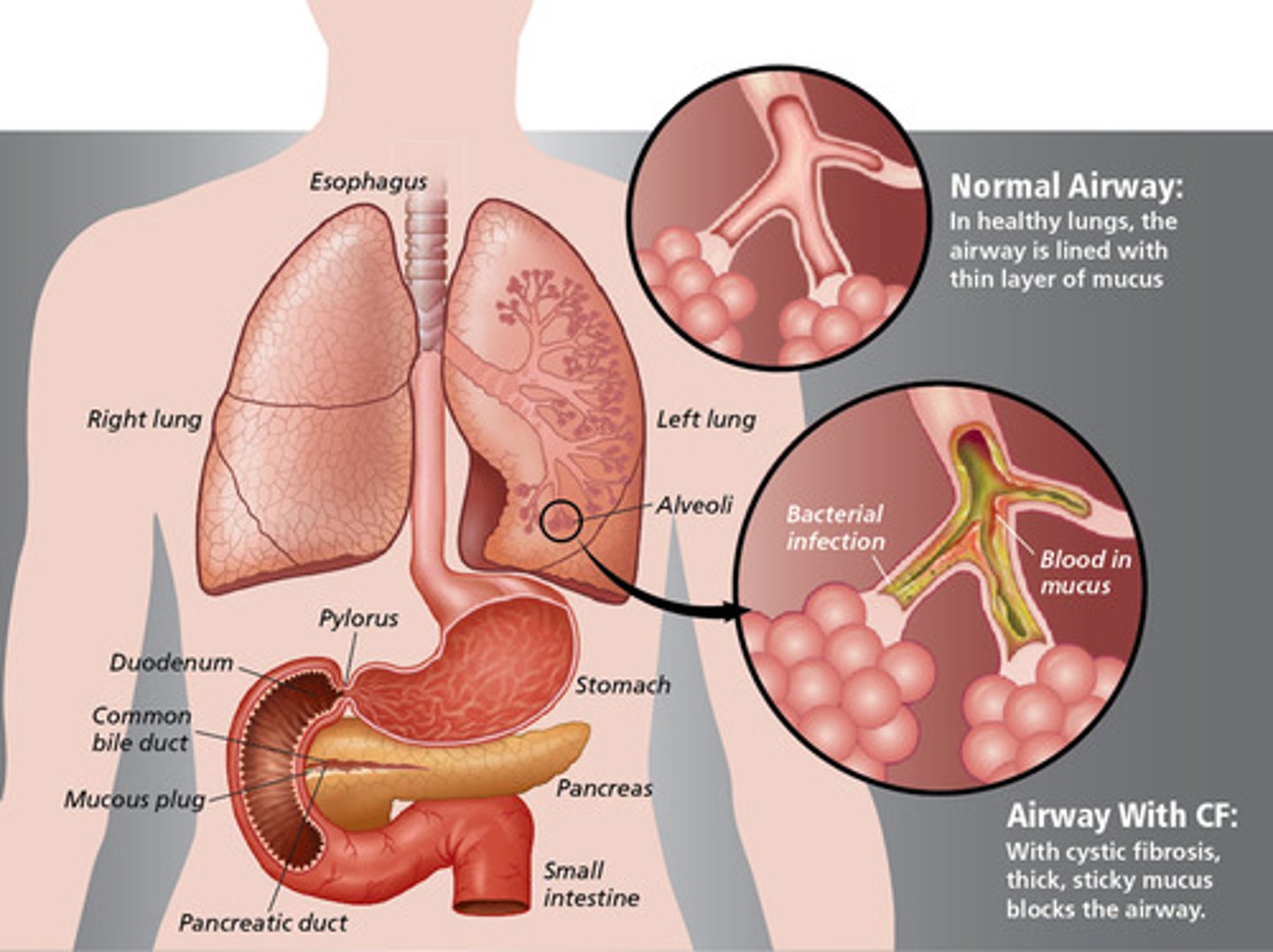 <p>Cystic Fibrosis</p>
