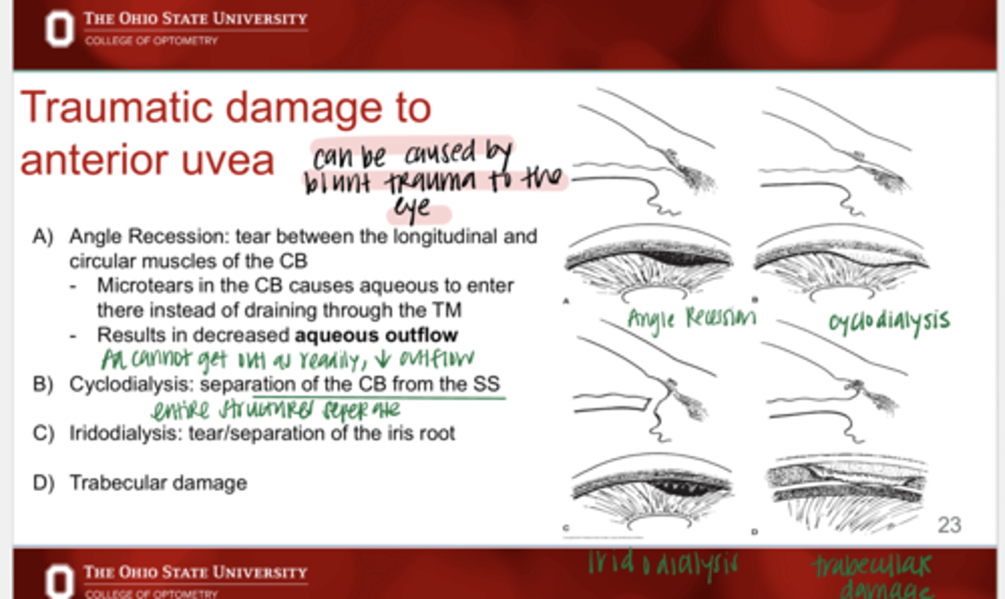 <p>What are the 4 effects of traumatic damage to the anterior uvea?</p>