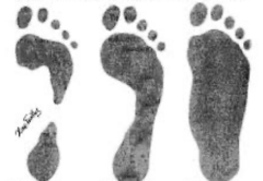 <p>CC: mostly asymptomatic</p><p>- Reported excessive valgus of the hindfoot</p><p>- Outersole wear pattern</p>