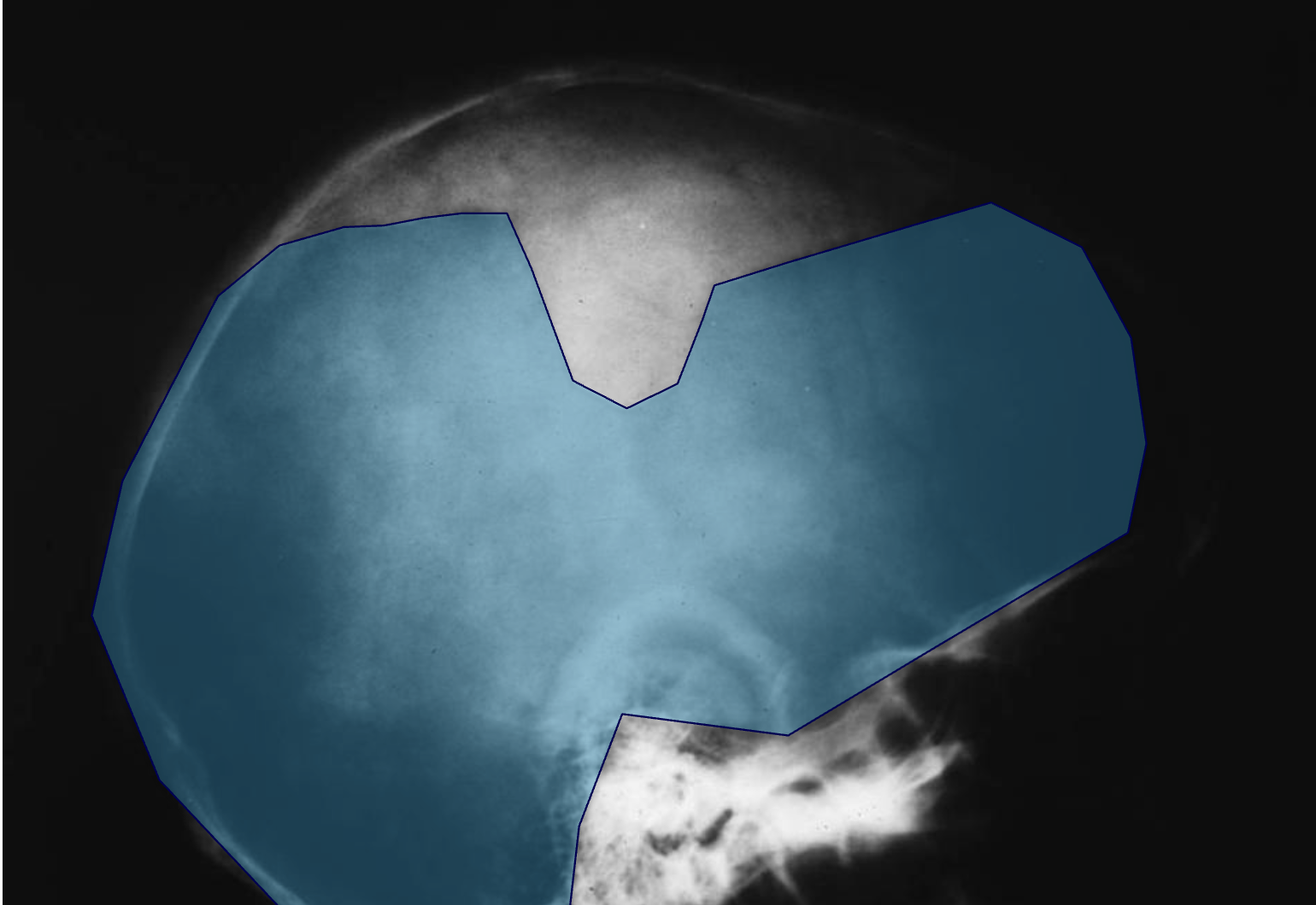 <p>What tumour like disorder is this, where is it, what can be seen?</p>