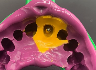 <ol><li><p>Take an impression of the canal</p></li><li><p>Lab fabricates a custom cast post and core</p></li><li><p>You cement the single metal unit</p></li></ol><p></p>