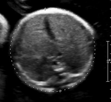 <p>Absent or small stomach</p><p>Polyhydramnios</p><p>Intrauterine growth restriction</p>