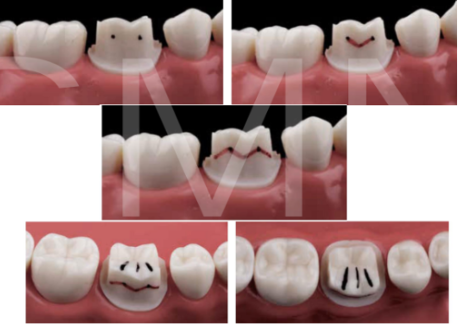 <ul><li><p>orientacijski žlebi s pilot svedrom</p></li><li><p>izravnavanje žlebov</p></li><li><p>ločitev od sosednjih zob z koničastim svedrom</p></li><li><p>orientacijski žlebovi oralno, sproti ustvarjamo stopnico</p></li><li><p>okluzalna ploskev: najprej žlebovi - najprej v fisuri, potem na vrških</p></li><li><p>2 mm pod bukalnima vrškoma lahko naredimo 2 črni piki, eno pa 2mm pod fisuro (dobimo črko V), potem še 2 točki 2mm pod mezialnim in distalnim obrobnim grebenom</p></li><li><p>poševni prehod med okluzalno in vestibularno površino</p></li><li><p>dodelamo stopnico z valjastim svedrom z zaobljenim vrhom (vestibularno in aproksimalno širša, palatinalno in supragingivalno pa ožja)</p></li></ul><p></p>