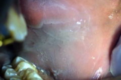 <p>today, a patient of African origin reported seeing this "unusual white area" in her buccal mucosa. the patient did not mention if she was taking any medication and her medical history has not changed since the last visit. the lesion cannot be rubbed off and does not hurt. what is this most likely to be?</p>