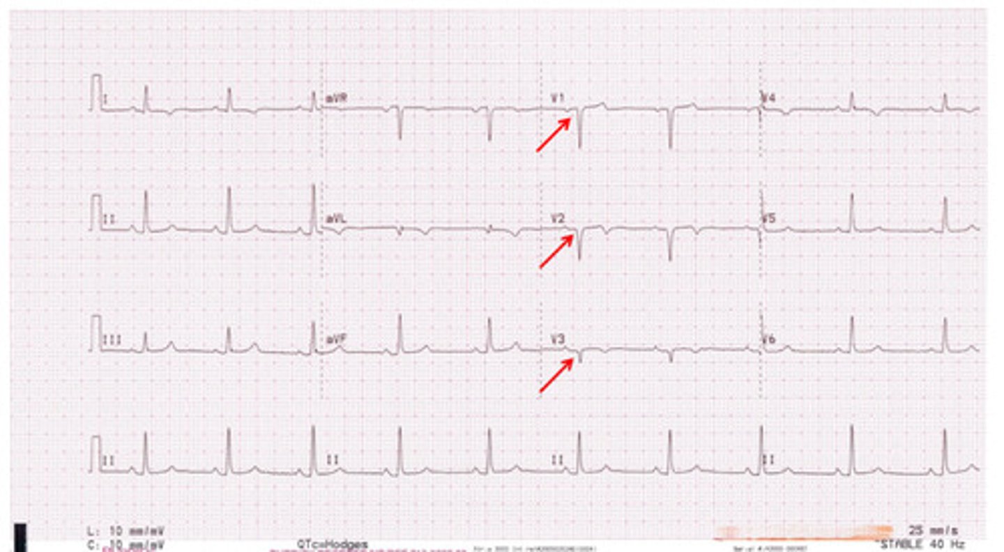 <p>this ekg shows ______ Q waves</p>