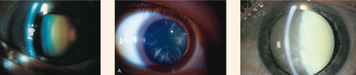 <p>What is the difference between these 3 types of cataracts</p>