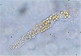 <p>matrix contains free fat globules, oval fat bodies, and matrix can be hyaline or granular</p>