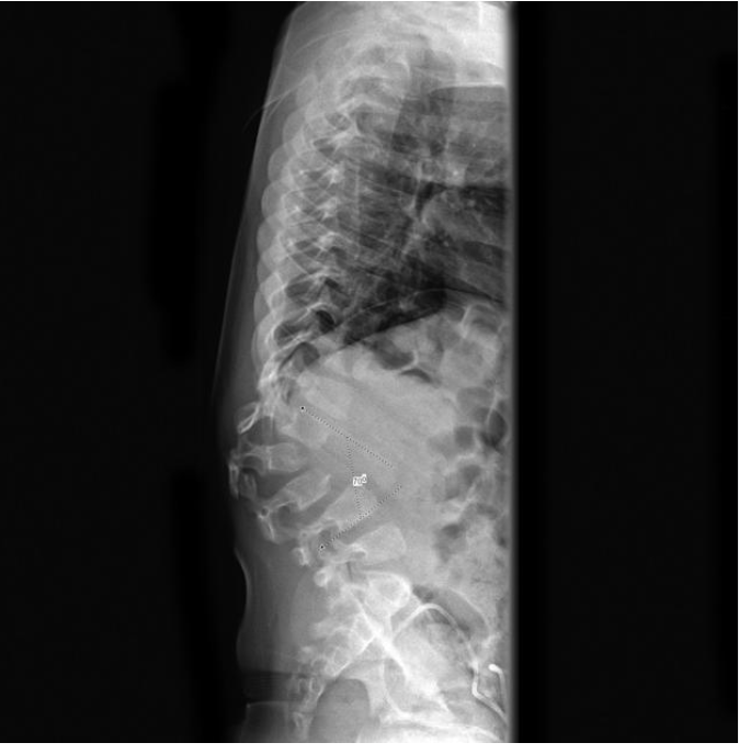 <p>A structural spinal condition characterized by a sharp, angular curve in the upper spine, resulting in a pronounced hump-like appearance</p>