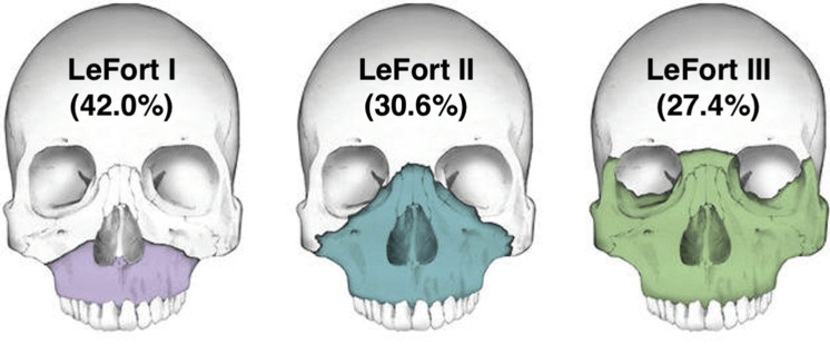 <p>LeFort III, because it completely separates the midface skeleton from the cranial base</p>