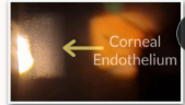 <p>Angle of incidence of illumination is equal to angle of observation</p><p><strong>Purkinjie image 1 </strong>- front surface of cornea</p><p><strong>Purkinjie image 2 </strong>- endothelium, where there is a change of R.index from cornea to aqueous</p><p><strong>Purkinjie image 3 </strong>- front surface of the lens</p><p><strong>Purkinjie image 4 </strong>- back surface of crystalline lens</p><p>Medium to high magnification</p><p>Focus on area of interest and swing illumination beam until specular reflection achieved</p><p>Only visible through one eyepiece at a time</p>