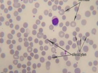 <p>kleine kogelvormige rbc, bij AIHA (Auto-Immune Hemolytic Anemia, eigen RBC aanvallen en vernietigen) </p>