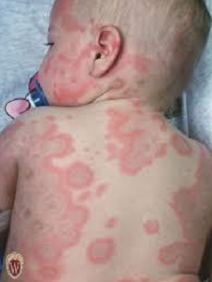 <p>Describe this lesion</p>