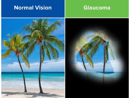 <p>loss of peripheral vision </p>