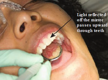 <ul><li><p>Directing light off mirror surface and through anterior teeth</p></li><li><p><strong>Trans </strong>= through</p></li><li><p><strong>Illumination </strong>= light up</p></li></ul><p></p><p>As light is reflected off mirror surface, light beams pass back through the teeth</p><ul><li><p>Light path through teeth to detect abnormalities (ex: cracks, cavities, dark shadows)</p></li></ul><p></p>