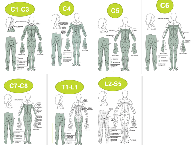 <p>C1–C3 outcomes → Ventilator dependent, fully dependent</p><p>C4 → ventilator dependent, small shoulder control</p><p>C5 function → Can eat/groom but not transfer, have biceps/deltoids</p><p>C6 function → Wrist extension (tenodesis grasp)</p><p>C7–C8 function → Independent transfers + ADLs</p><p>T1–T12 function → Independent, possible limited walking with aids</p><p>L2-S5 function → Full independence in any environment; rapid come back.</p>
