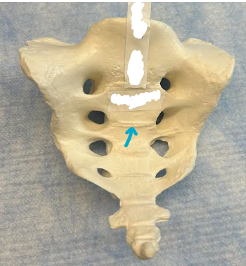 <p>ID sacrum/coccyx region</p>