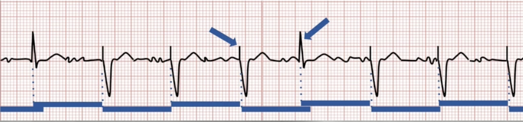 <ul><li><p>Determined by LRL (60000/rate = interval)</p></li><li><p>Begins after every paced or sensed beat</p></li><li><p>Device paces when interval times out</p></li><li><p>Sensing will lead to inhibition and reset the pacing interval</p></li></ul><p></p>