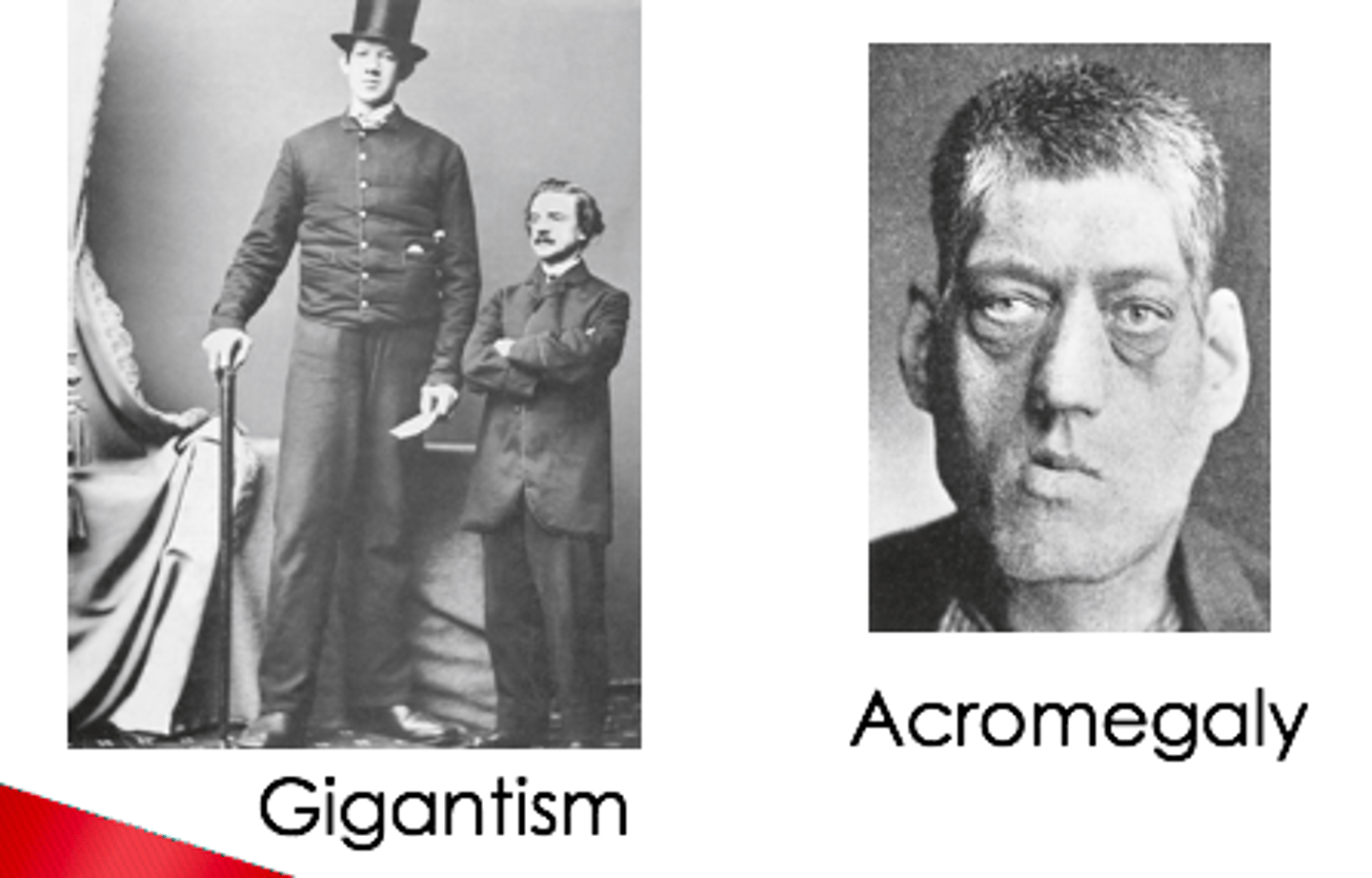 <p>Gigantism - Excess HGH before puberty</p><p>-Results in extreme height (over 2.1m)</p><p>-Often caused by a pituitary tumour</p><p>-Enlargement of hands, feet and facial bones</p><p>Acromegaly - Excess HGH after puberty</p><p>-Abnormal growth of bones and soft tissues</p><p>-Commonly affecting middle-aged adults</p><p>-Causes facial distortion and reduced lifespan if untreated.</p>