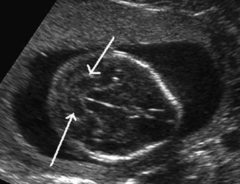 <p>elongation / squishing of the cerebellum showing a posterior fossa abnormality and obliteration of the cisterns magna.</p>