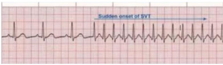 <ul><li><p><span style="background-color: transparent;">Heart rate suddenly speeds up</span></p></li><li><p><span style="background-color: transparent;">Premature atrial contraction</span></p></li><li><p><span style="background-color: transparent;">P waves are lost</span></p></li><li><p><span style="background-color: transparent;">Narrow QRS</span></p></li></ul><p></p>