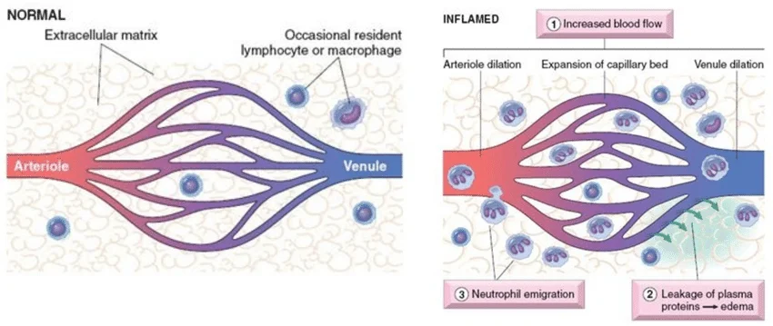 <p><strong>inflammation</strong></p><ul><li><p>endothelial cellls <strong>contract</strong> when triggered by histamines or bradykinan during inflammatory response</p></li><li><p>cells <strong>contract</strong> → bigger <strong>gaps</strong> in between</p></li><li><p>bigger gaps → allow <strong><u>exudate</u></strong> (plasma, proteins, WBCs) to leak out</p></li></ul><p></p>