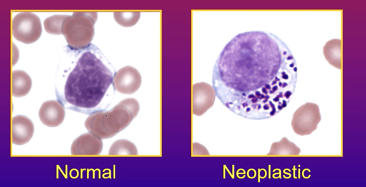 <p>Neoplastic lymphocytes have granules → lymphoma</p>