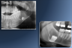 <p>What cyst is this?</p>