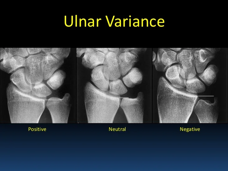 <p>-Length of the ulna compared to the length of the radius at the wrist.</p><p>-Neutral Ulnar Variance: End of the ulna is in line with end of the radius (Normal)</p><p>-Negative Ulnar Variance: Ulna is shorter than the radius (Keinbock’s Disease/AVN lunate)</p><p>-Positive Ulnar Radiance: Ulna is longer than the radius (TFCC Degen)</p>