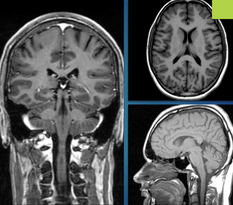 <p>radiation free medical imaging technique that uses powerful magenetic fields (10,000-60,000) times stronger than earth’s magnetic field </p>