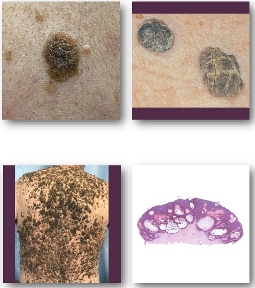 <ul><li><p>Benign proliferation of epidermal basal cells</p></li></ul><p>• Etiology linked to aging and sun exposure</p><p>• Associated with FGFR3 and PIK3CA mutations</p><p>• Extremely common in older adult population</p><p>• Oral involvement is extremely rare</p>