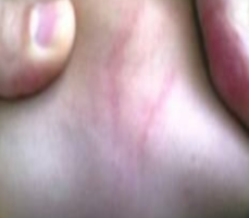 <p>pastia’s lines definition</p>