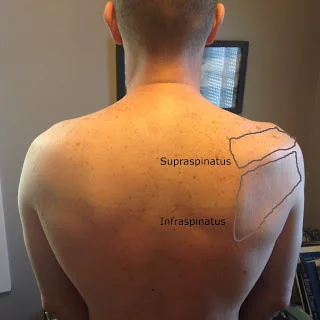 <p><strong>Location</strong>: Greater tubercle, anterior to acromion.</p><p><strong>How to Palpate:</strong></p><ul><li><p>Extend patient’s arm behind back or slight extension.</p></li></ul><p></p><p>Confirm: Patient abducts arm lightly—tendon firms under finger.</p>