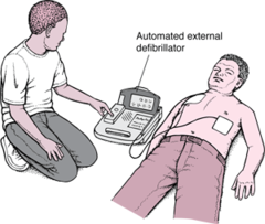 <p>When AED is analyzing the rhythm (minimize interruptions in compressions)</p>